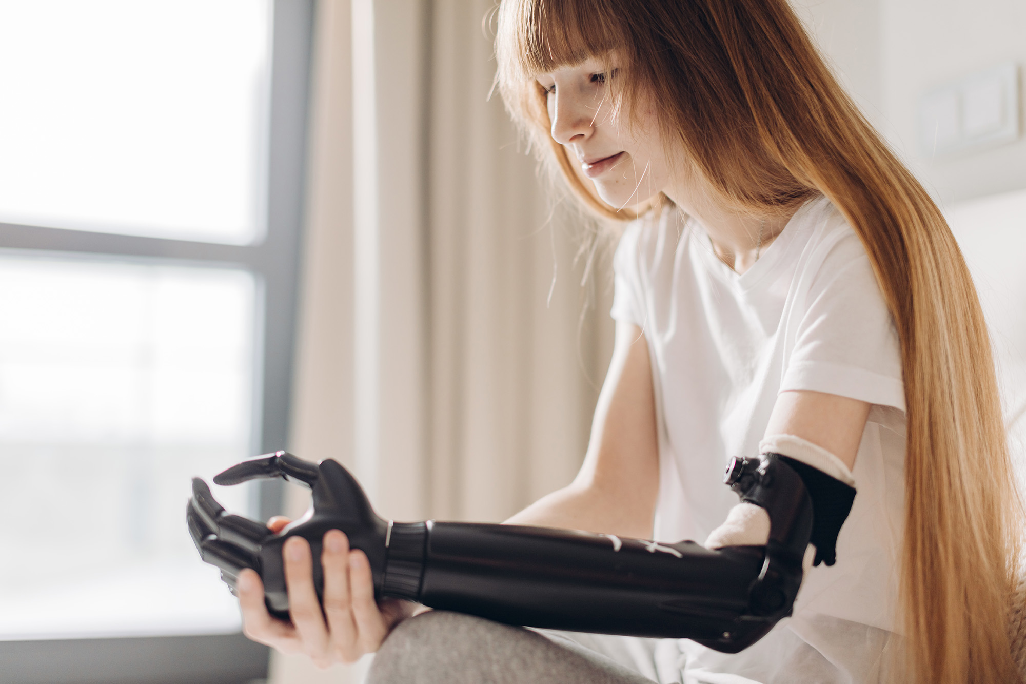 Prosthetic Arm - Limb Loss, Arm Injury, Lost hand, Injury Claims Wakefield
